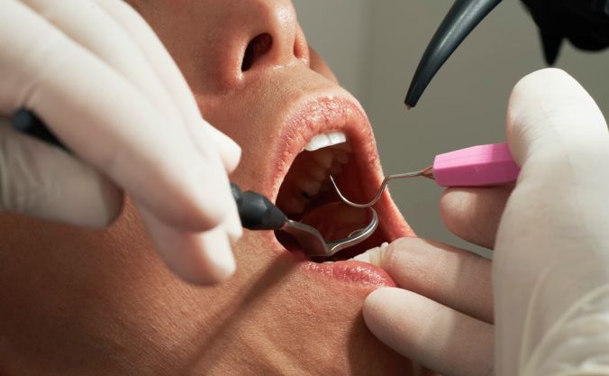 que es periodontitits